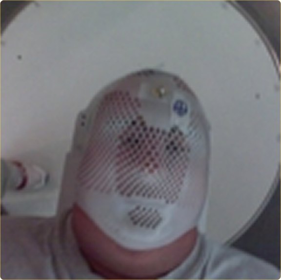 Jeff with his radiation treatment mask. The mask was bolted to the radiation table to ensure absolutely no movement of his head during the treatments.
